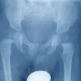 Radiografia del bacino e delle anche, evidenzia un'osteocondrosi dell'anca, con alterazioni della testa del femore.
