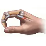 Dito cosa fare per il pollice a scatto: infiammazione del tendine e della guaina tendinea.