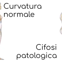 Scheletri a confronto: uno con curvatura normale, l'altro con cifosi patologica, evidenziando la curvatura lombare alterata.