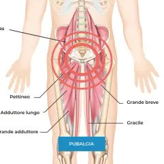 Anatomia della pubalgia: focus su psoas, pettineo, adduttori e gracile. Scopri come curare la pubalgia velocemente con esercizi mirati.