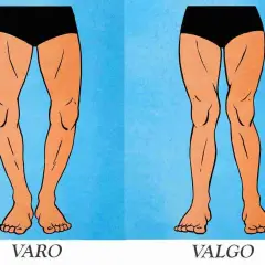Gambe con valgismo (ginocchia a X) e varismo (ginocchia arcuate). Confronto visivo tra le due condizioni.