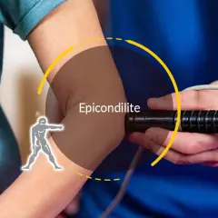 Trattamento per epicondilite: un dispositivo medico applicato al gomito per alleviare il dolore.