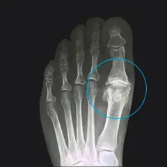Radiografia del piede che evidenzia l'alluce rigido, con deformità e fusione ossea nell'articolazione metatarso-falangea.