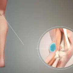 Ingrandimento del ginocchio che mostra una cisti di Baker, un rigonfiamento dietro il ginocchio.