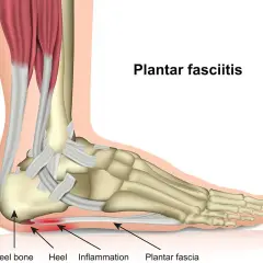 Anatomia del piede con fascite plantare, infiammazione del tallone. Il magnesio può aiutare.