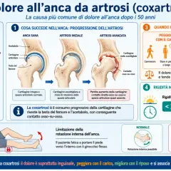 Dolore all'anca da artrosi: la **contusione anca** è tipicamente inguinale, peggiora con il carico e migliora col riposo.