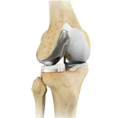 Protesi al ginocchio: un'immagine anatomica che mostra la sostituzione articolare. Quanto dura il dolore dopo la protesi al ginocchio?