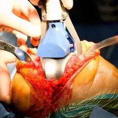Chirurgia per protesi al ginocchio: i tempi di recupero dipendono da molti fattori.