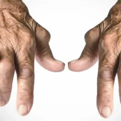 Mani con segni di rizoartrosi. Il freddo o il caldo possono influenzare il dolore.