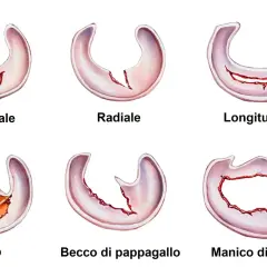 Illustrazioni di vari tipi di menisco rotto: orizzontale, radiale, longitudinale, a lembo, a becco di pappagallo e a manico di secchio.