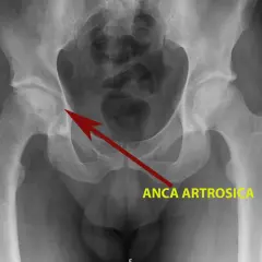 Radiografia del bacino che mostra un'anca artrosica, con freccia rossa che indica l'area interessata.