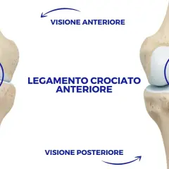 Legamento crociato anteriore rotto in visione anteriore e posteriore del ginocchio.