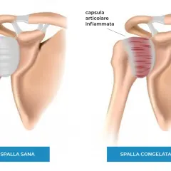 Spalla sana vs spalla congelata: la capsula articolare infiammata mostra i sintomi di dolore e rigidità.