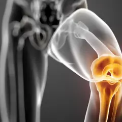 Illustrazione 3D di un ginocchio con evidenziata la meniscosi del corno posteriore del menisco mediale, che indica un'area di potenziale lesione.