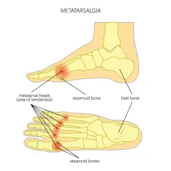 Illustrazione anatomica del piede che mostra l'infiammazione metatarso, con aree di dolorabilità evidenziate nelle teste metatarsali.