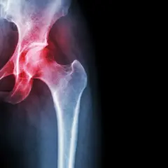 Radiografia del bacino con evidenza di trocanterite. Camminare fa bene per migliorare la mobilità dell'anca.