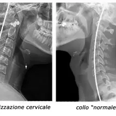 Radiografie cervicali: a sinistra, rettilineizzazione del rachide cervicale con frecce che indicano possibili conseguenze; a destra, collo "normale".