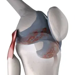 Dettaglio anatomico di un ginocchio con cartilagine danneggiata, che suggerisce ginocchia che scricchiolano.