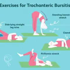 Esercizi per la trocanterite: sollevamento gamba laterale, stretching ischiocrurali, clamshell e piriforme. Rimedi efficaci.
