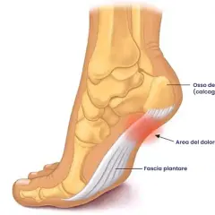 Illustrazione anatomica del piede che mostra il dolore al tallone come spilli, con la fascia plantare infiammata e l'osso del tallone.