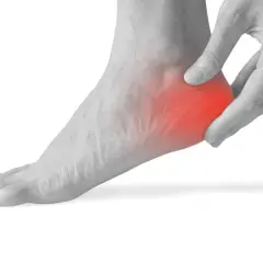 Piede con dolore al tallone, evidenziato in rosso. Utile per illustrare spina calcaneare esercizi.