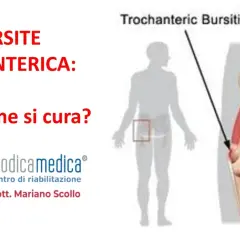 Borsite trocanterica che non passa? Immagine illustra la condizione e le opzioni di cura.