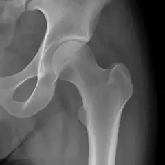 Radiografia dell'anca che mostra una calcificazione ossea.