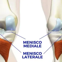 Illustrazione anatomica del ginocchio che evidenzia il menisco mediale e il menisco laterale, strutture cartilaginee essenziali per la stabilità e il movimento.
