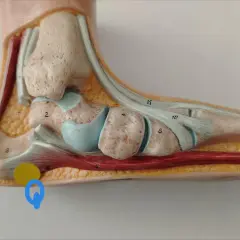Modello anatomico del piede evidenzia la spina calcaneare trascurata, con aree di interesse cerchiate in giallo e blu.