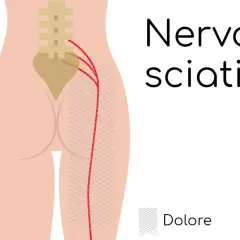 Illustrazione anatomica del nervo sciatico e del lombo cruralgia. Il dolore si irradia lungo la gamba.