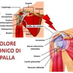 Dolore cronico di spalla destra quando alzo il braccio, con illustrazioni anatomiche della cuffia dei rotatori e dei muscoli della spalla.