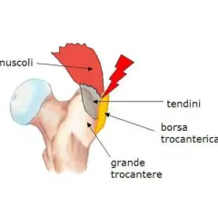Diagramma anatomico dell'anca che mostra il grande trocantere, i muscoli, i tendini e la borsa trocanterica, evidenziando un'area di potenziale infiammazione.