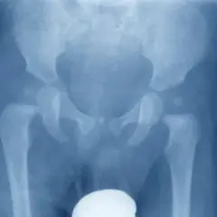 Radiografia del bacino e delle anche, evidenzia un'osteocondrosi dell'anca, con alterazioni della testa del femore.