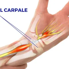 Illustrazione anatomica del tunnel carpale con evidenziata la compressione del nervo, che può richiedere un intervento.