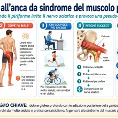 Dolore all'anca da sindrome del piriforme, che irrita il nervo sciatico causando una pseudo-sciatalgia. Immagine illustra cause, sintomi e diagnosi.