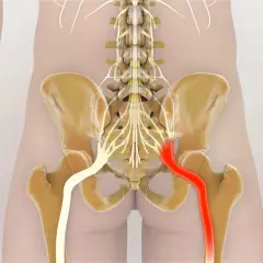 Illustrazione anatomica del nervo sciatico, con enfasi sui **sciatalgia sintomi inguine**. Il nervo destro è evidenziato in rosso, indicando potenziale irritazione o infiammazione.