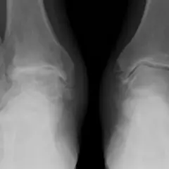 Radiografie delle caviglie mostrano segni di artrosi, con alterazioni ossee e riduzione dello spazio articolare.