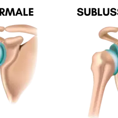 Spalla normale vs. sublussazione: quando il dolore spalla sinistra quando preoccuparsi? Illustrazione anatomica.