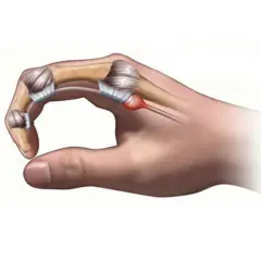 Dito cosa fare per il pollice a scatto: infiammazione del tendine e della guaina tendinea.