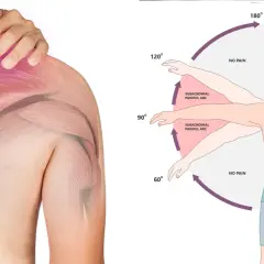 Illustrazione anatomica della spalla con dolore e diagramma che mostra gli esercizi per la spalla congelata, evidenziando l'arco doloroso.