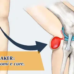 Illustrazione anatomica di una cisti di Baker nel ginocchio, con indicazioni su cause, sintomi e cure. I tempi di guarigione variano.