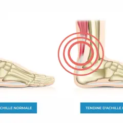 Confronto tra tendine d'Achille normale e infiammato. L'immagine mostra un piede con scheletro e muscolatura, evidenziando la differenza tra un tendine sano e uno irritato con cerchi rossi.