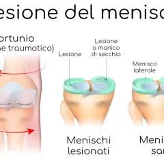 Illustrazione che mostra cos'è un menisco e le lesioni a manico di secchio, con menischi sani e lesionati.