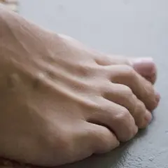 Piedi con gonfiore e arrossamento, possibili sintomi iniziali di artrite reumatoide.