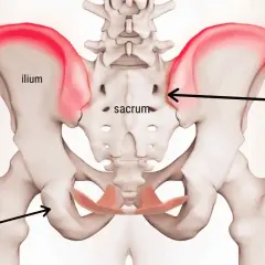 Anatomia del bacino con evidenziato il dolore alla cresta iliaca, sintomi comuni di infiammazione.