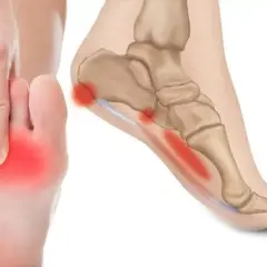 Dolore sotto tallone evidenziato in rosso su un piede e un'illustrazione anatomica.