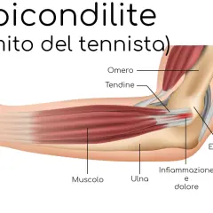 Illustrazione anatomica del gomito che mostra infiammazione e dolore, causa comune del dolore avambraccio tennis.