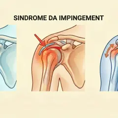 Illustrazione della sindrome da impingement alla spalla, che causa dolore spalla insopportabile.
