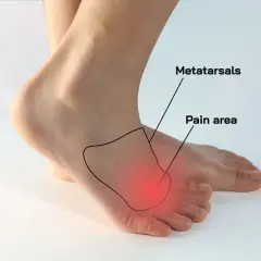 Area dolente del metatarso, indicata per capire come sfiammare il neuroma di Morton.