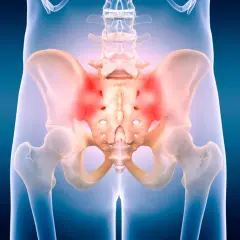 Dolore al cingolo pelvico evidenziato in rosso. L'immagine mostra l'anatomia del bacino e della colonna vertebrale inferiore con aree di infiammazione.